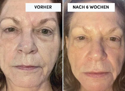 LEDEXIA - Die LED Maske für strahlende junge Haut